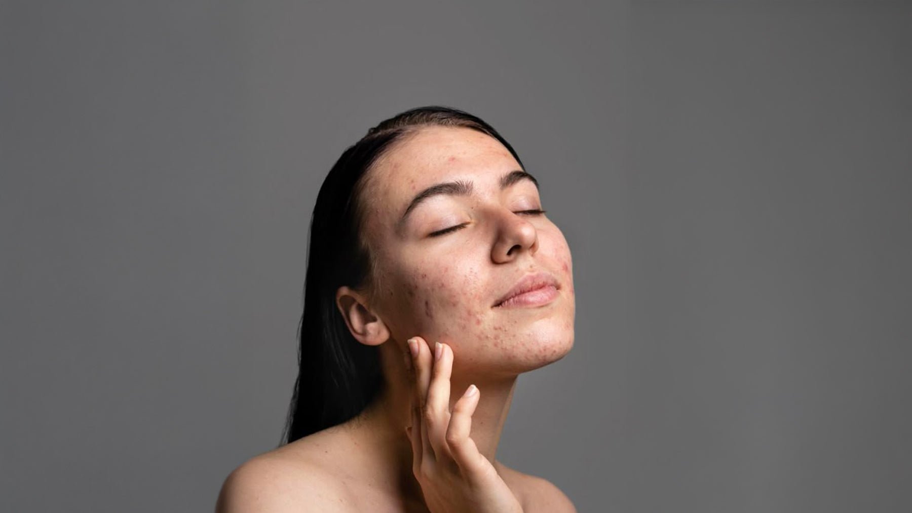 Hormonal Akne Neden Olur, Nasıl Geçer? - ya da multicosmetics